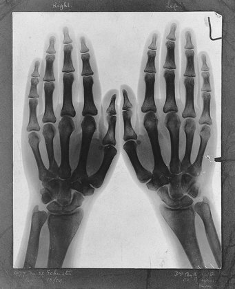 Two hands, viewed through x-ray. Photoprint from radiograph after Sir Arthur Schuster, 1896, photoprint from radiograph, albumen, 21.5 x 16.3 cm. London, United Kingdom, Wellcome Collection Two hands, viewed through x-ray. Photoprint from radiograph after Sir Arthur Schuster, 1896, photoprint from radiograph, albumen, 21.5 x 16.3 cm. London, United Kingdom, Wellcome Collection